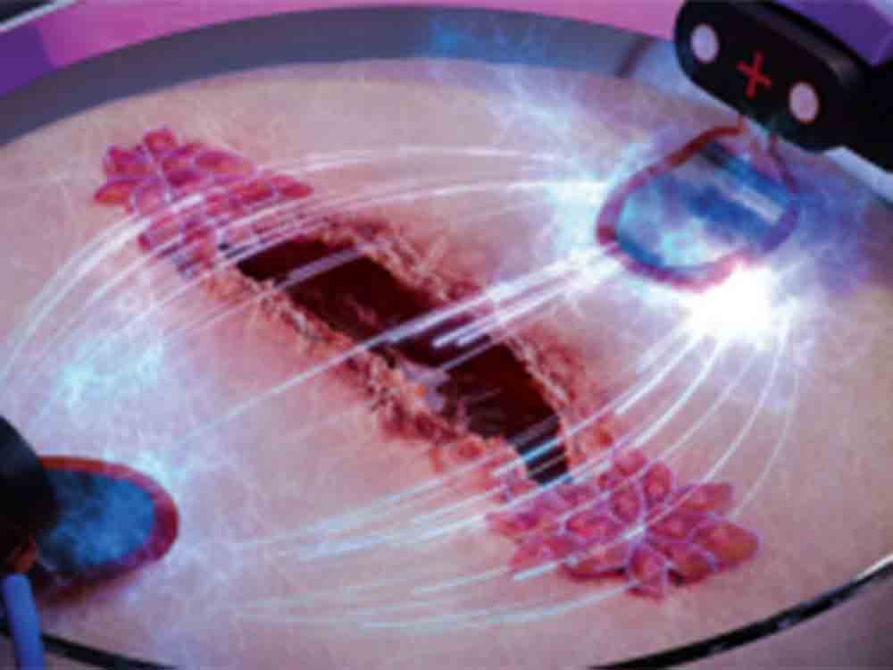Strom regeneriert chronische Wunden rascher, elektrische Steuerung der Hautzellen heilt 3 mal so schnell, neuer Ansatz für Diabeteskranke